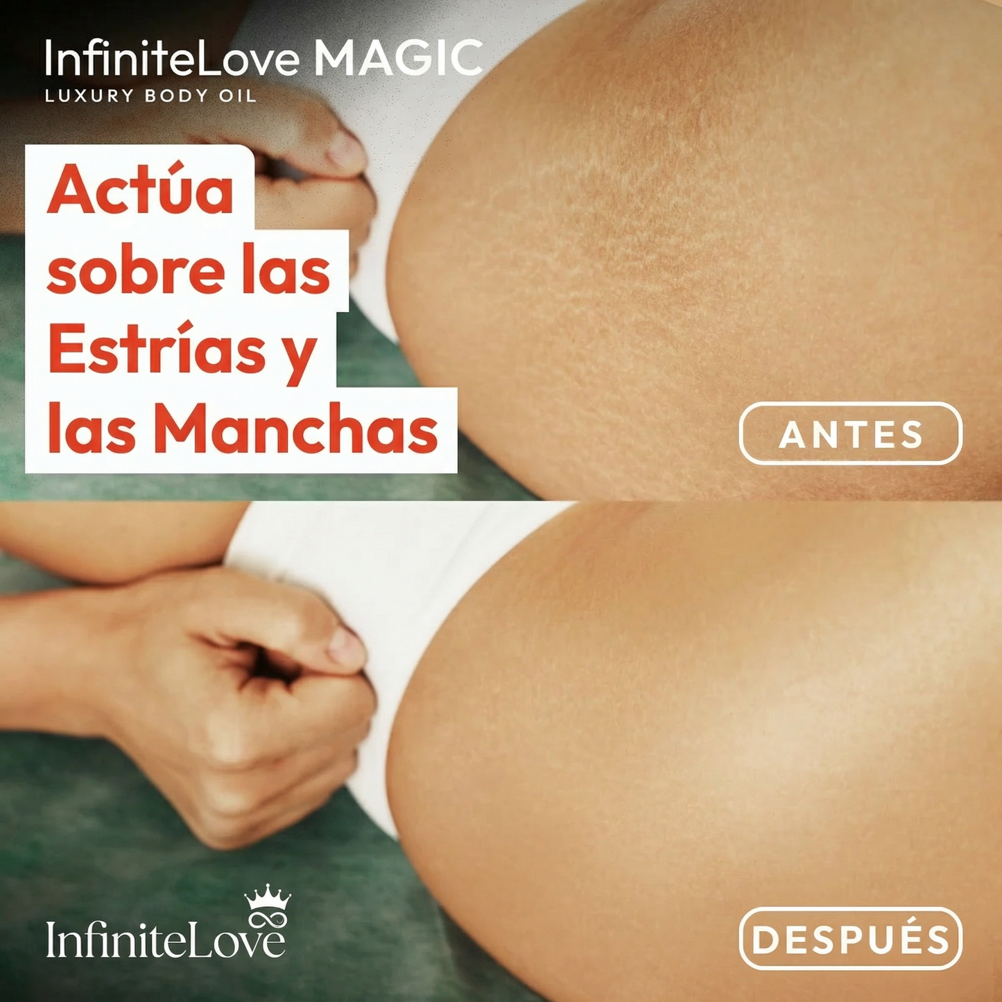 Aceite Corporal ElasticSkin™ – Estrías, Manchas y Piel Firme